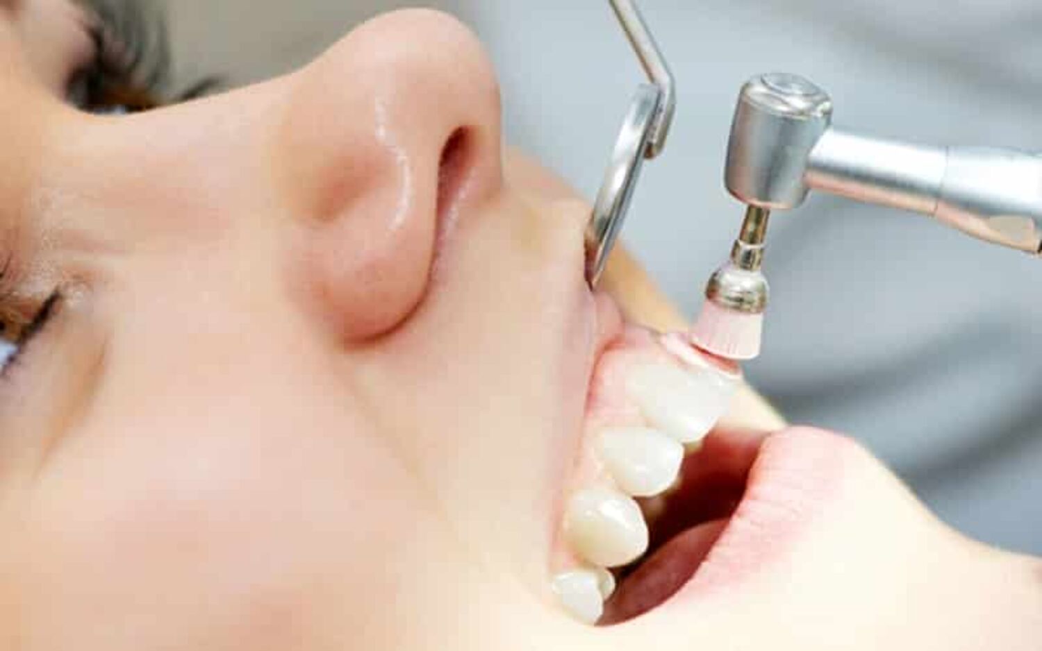  Profilaxis dental